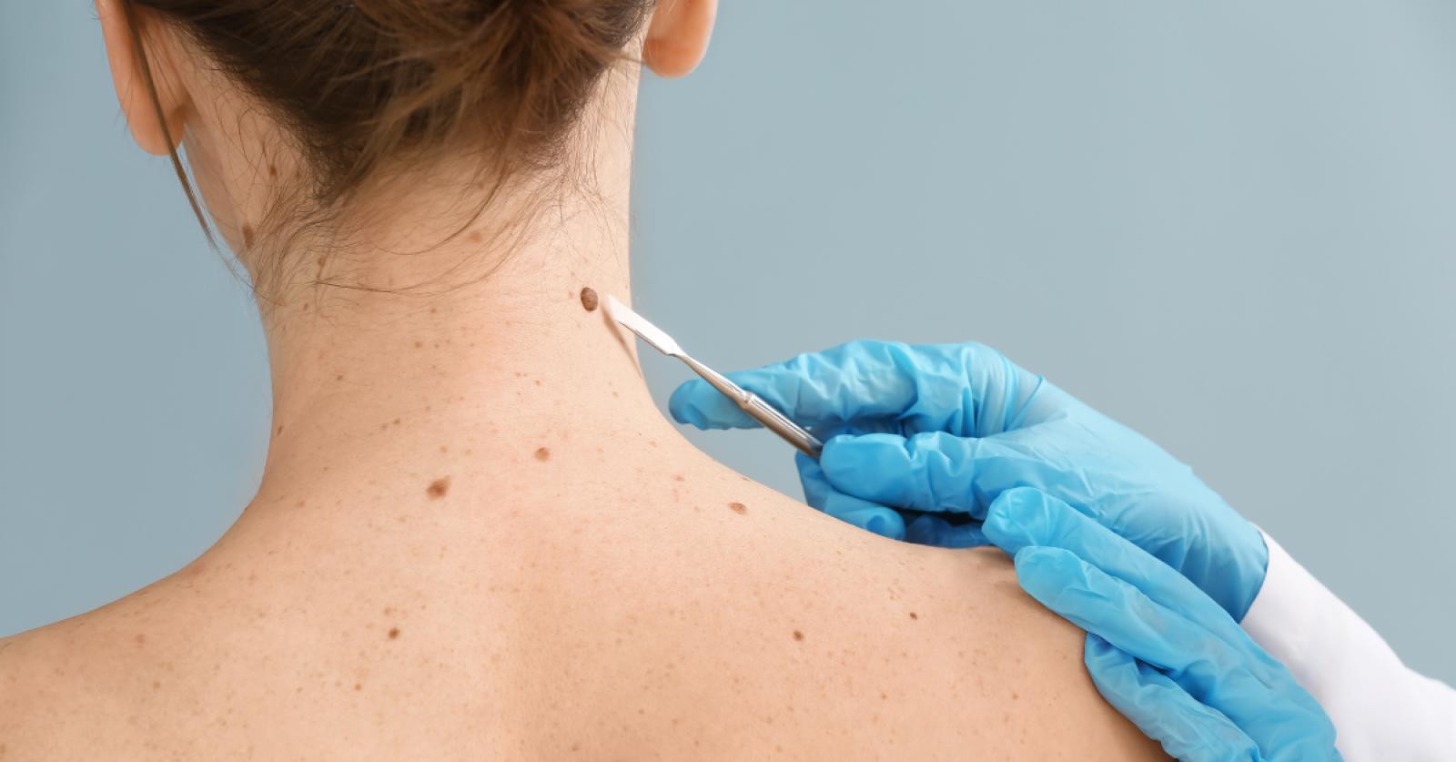 Melanoma & Skin Cancer: Why a Full-Body Skin Check Matters